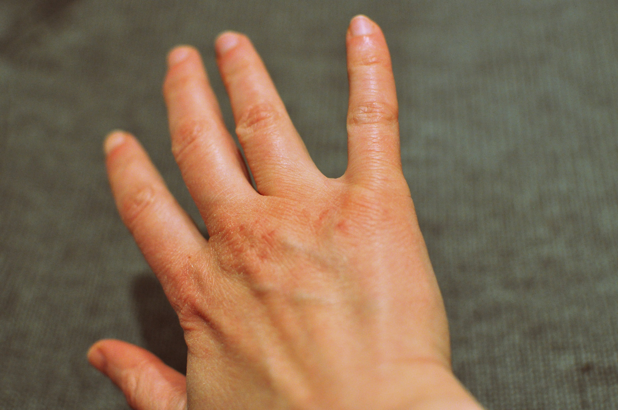 Stay on top of your diabetes skin care, and you won't end up with desiccated hands like this one ... photo by CC user  vialbost on Flickr