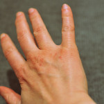 How to deal with diabetes skin care